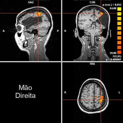 Pesquisa de métodos não invasivos para mapear regiões do cérebro pode ser usada em cirurgias de pacientes com epilepsia